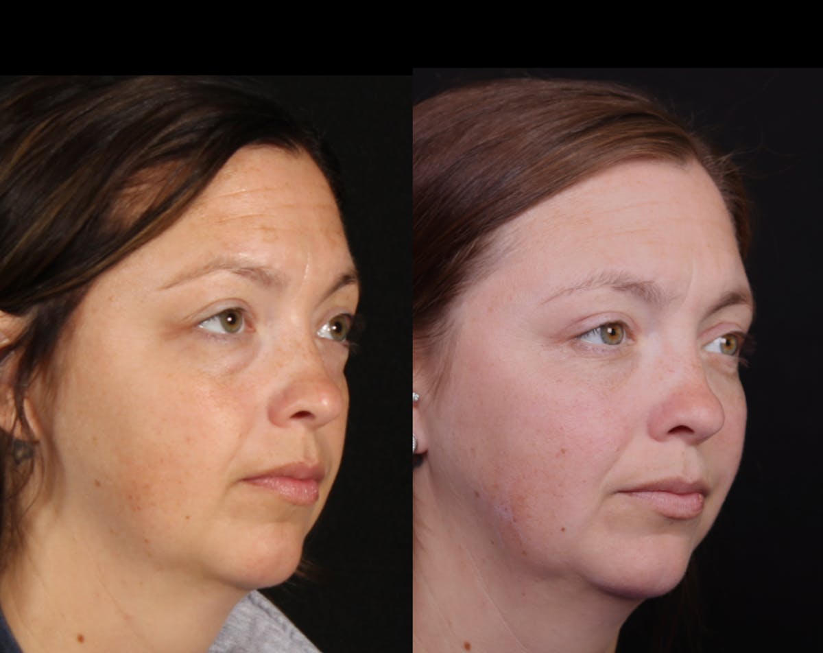 Blepharoplasty & Browlift Before & After Gallery - Patient 106388 - Image 3