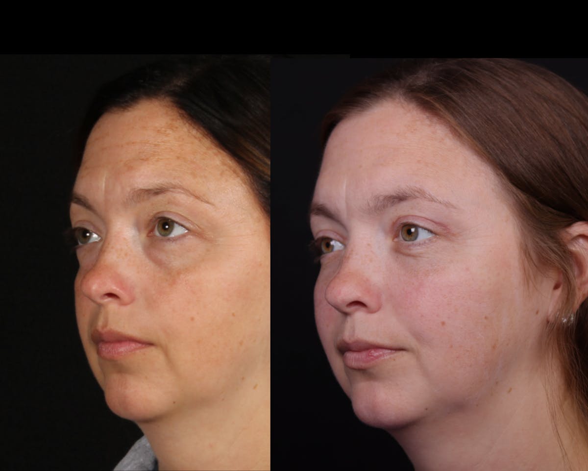 Blepharoplasty & Browlift Before & After Gallery - Patient 106388 - Image 5