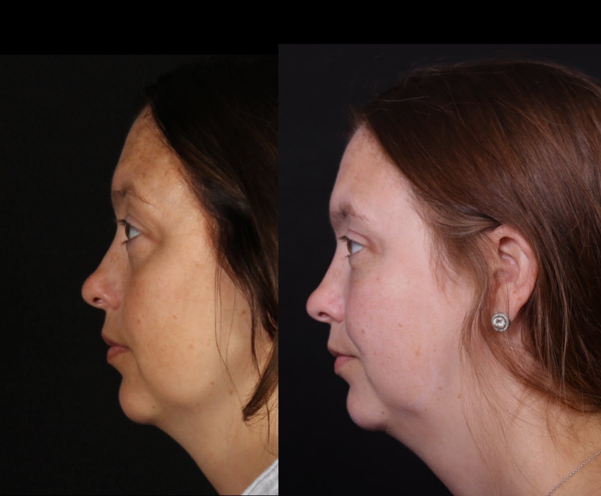 Blepharoplasty & Browlift Before & After Gallery - Patient 106388 - Image 6
