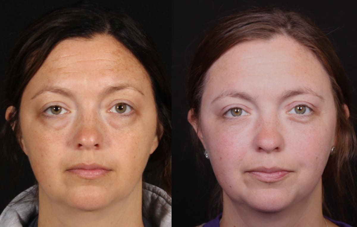 Blepharoplasty & Browlift Before & After Gallery - Patient 106388 - Image 1