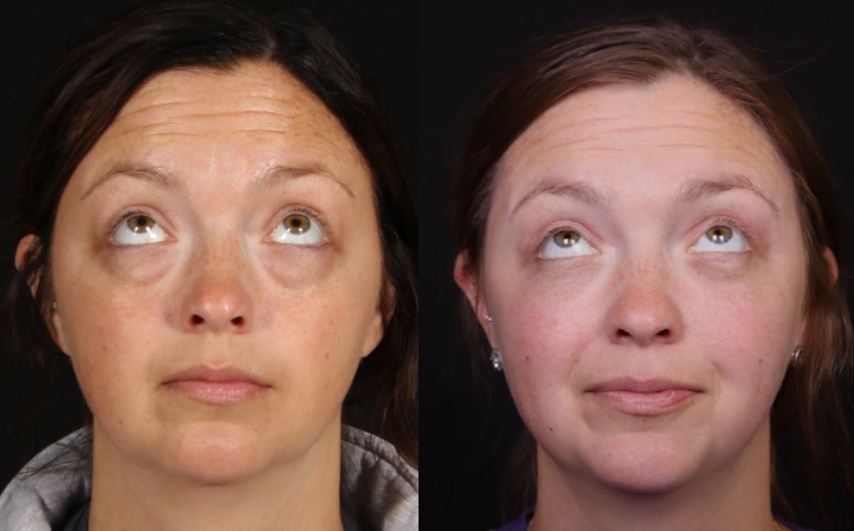 Blepharoplasty & Browlift Before & After Gallery - Patient 106388 - Image 2