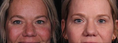 Blepharoplasty & Browlift Before & After Gallery - Patient 356858 - Image 1
