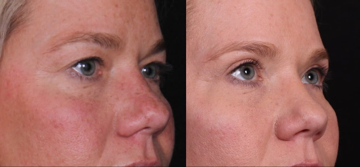 Blepharoplasty & Browlift Before & After Gallery - Patient 356858 - Image 2
