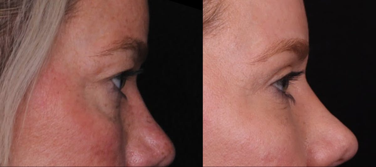 Blepharoplasty & Browlift Before & After Gallery - Patient 356858 - Image 3