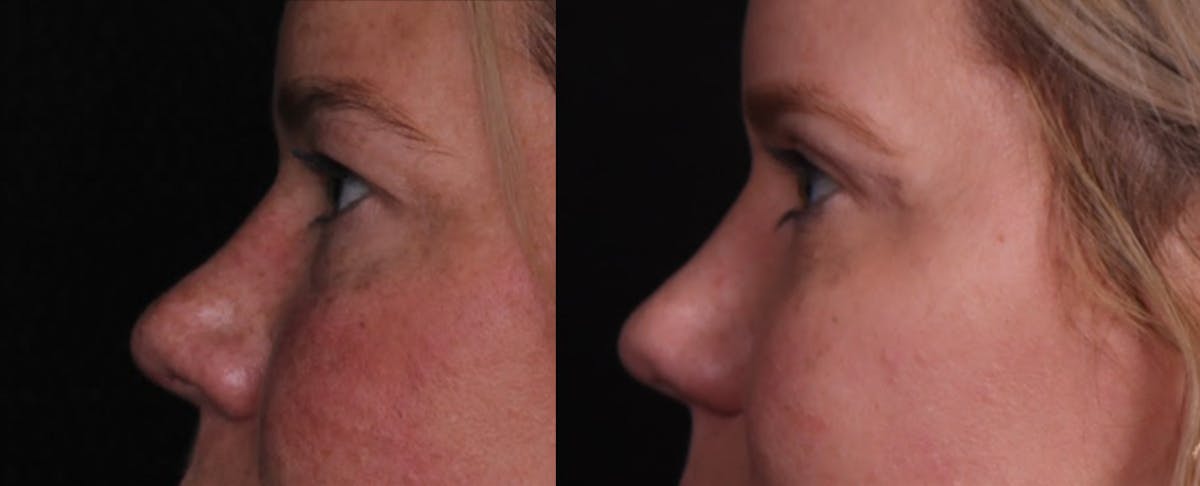 Blepharoplasty & Browlift Before & After Gallery - Patient 356858 - Image 5