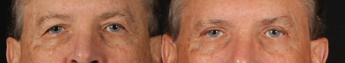 Blepharoplasty & Browlift Before & After Gallery - Patient 368979 - Image 1