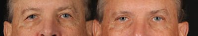 Blepharoplasty & Browlift Before & After Gallery - Patient 368979 - Image 1