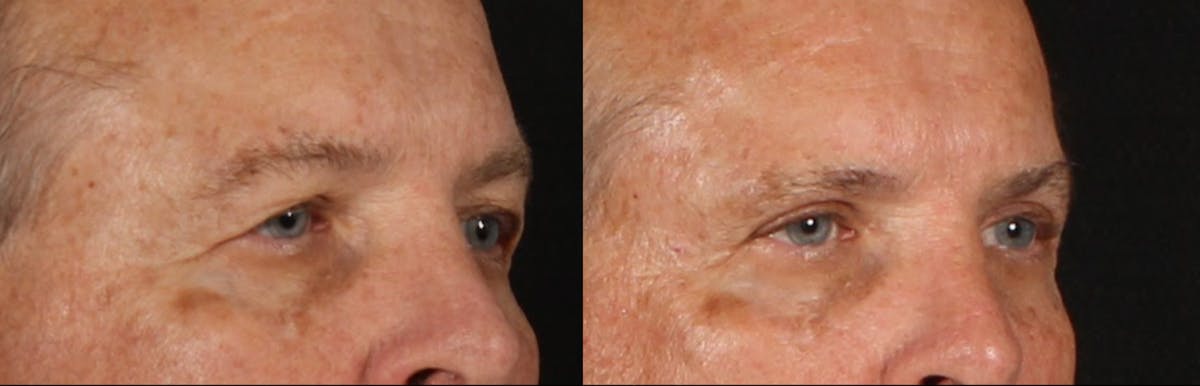 Blepharoplasty & Browlift Before & After Gallery - Patient 368979 - Image 2