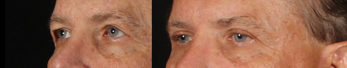 Blepharoplasty & Browlift Before & After Gallery - Patient 368979 - Image 3