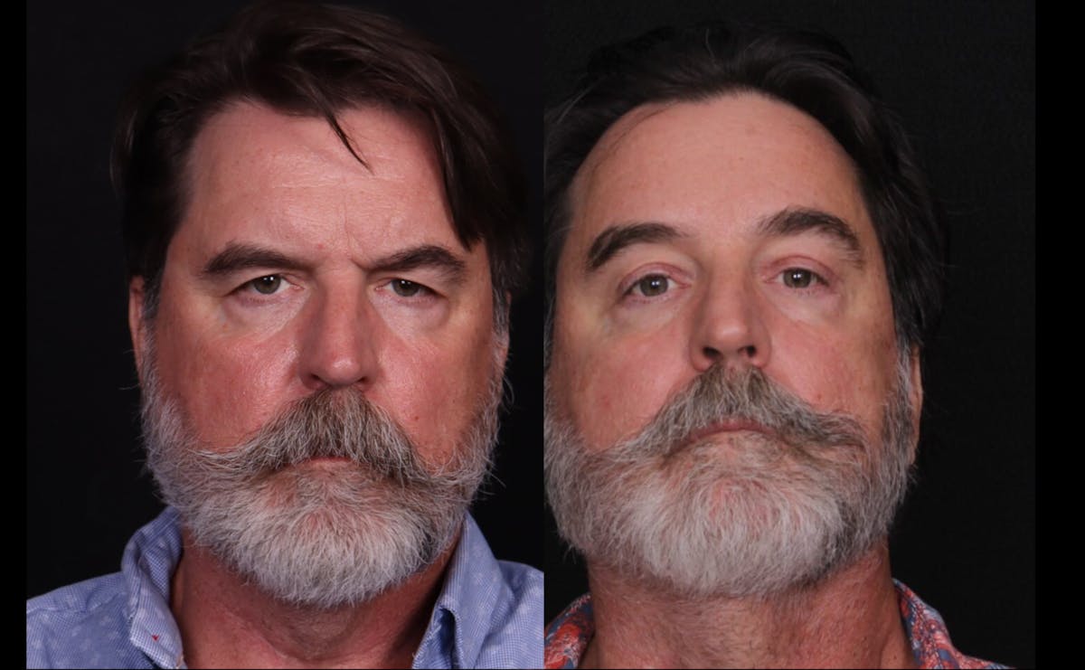 Blepharoplasty & Browlift Before & After Gallery - Patient 198883 - Image 1