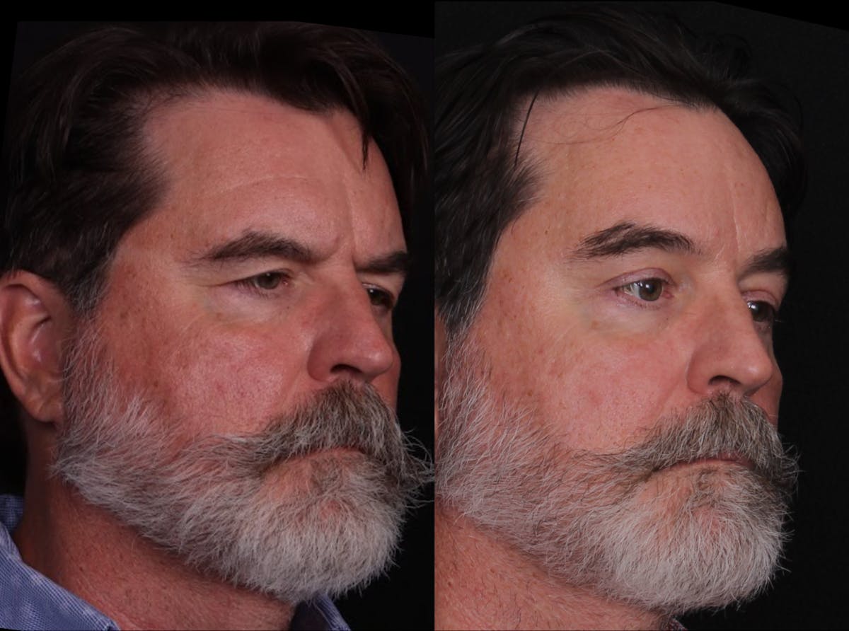 Blepharoplasty & Browlift Before & After Gallery - Patient 198883 - Image 2