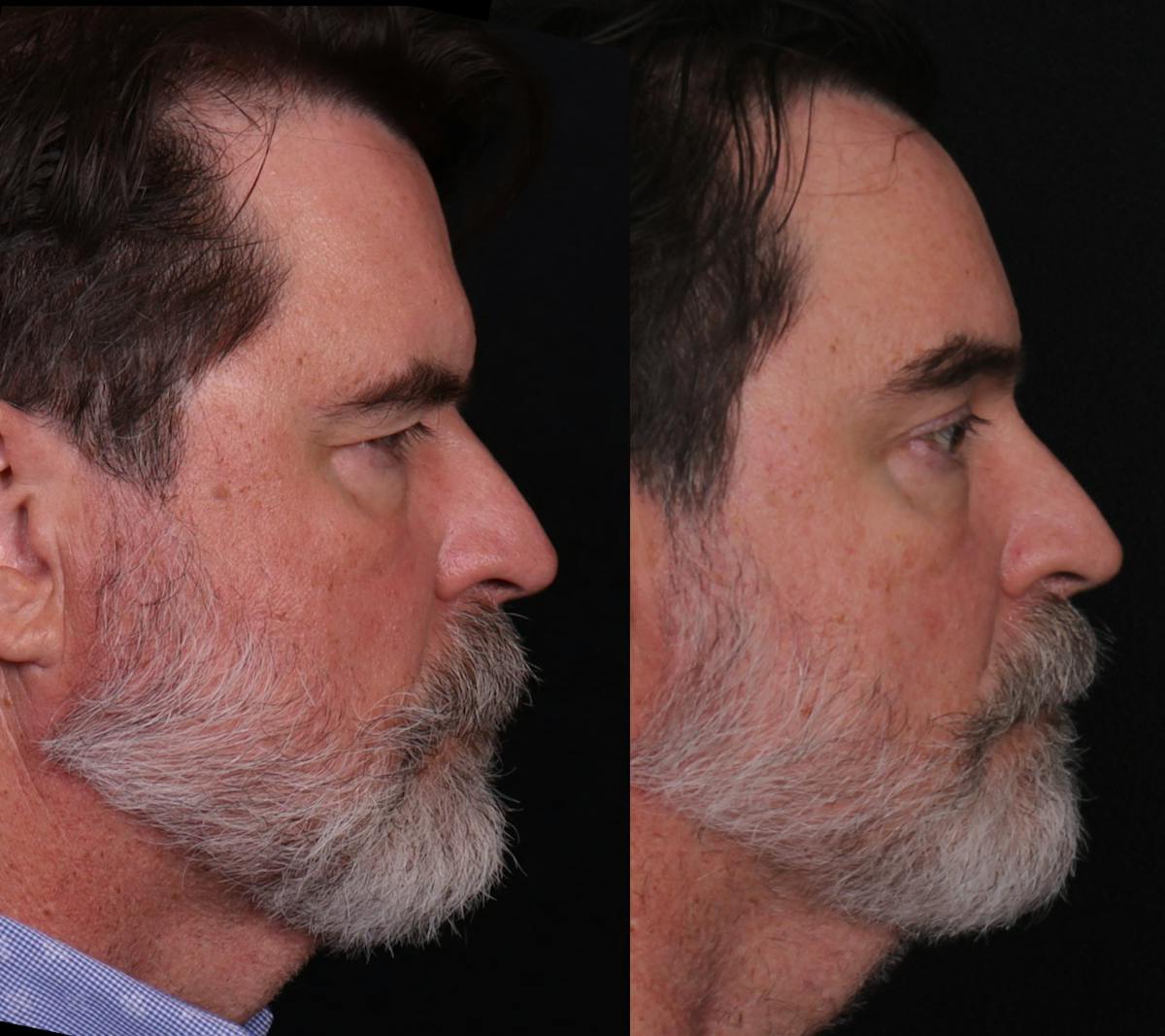 Blepharoplasty & Browlift Before & After Gallery - Patient 198883 - Image 3