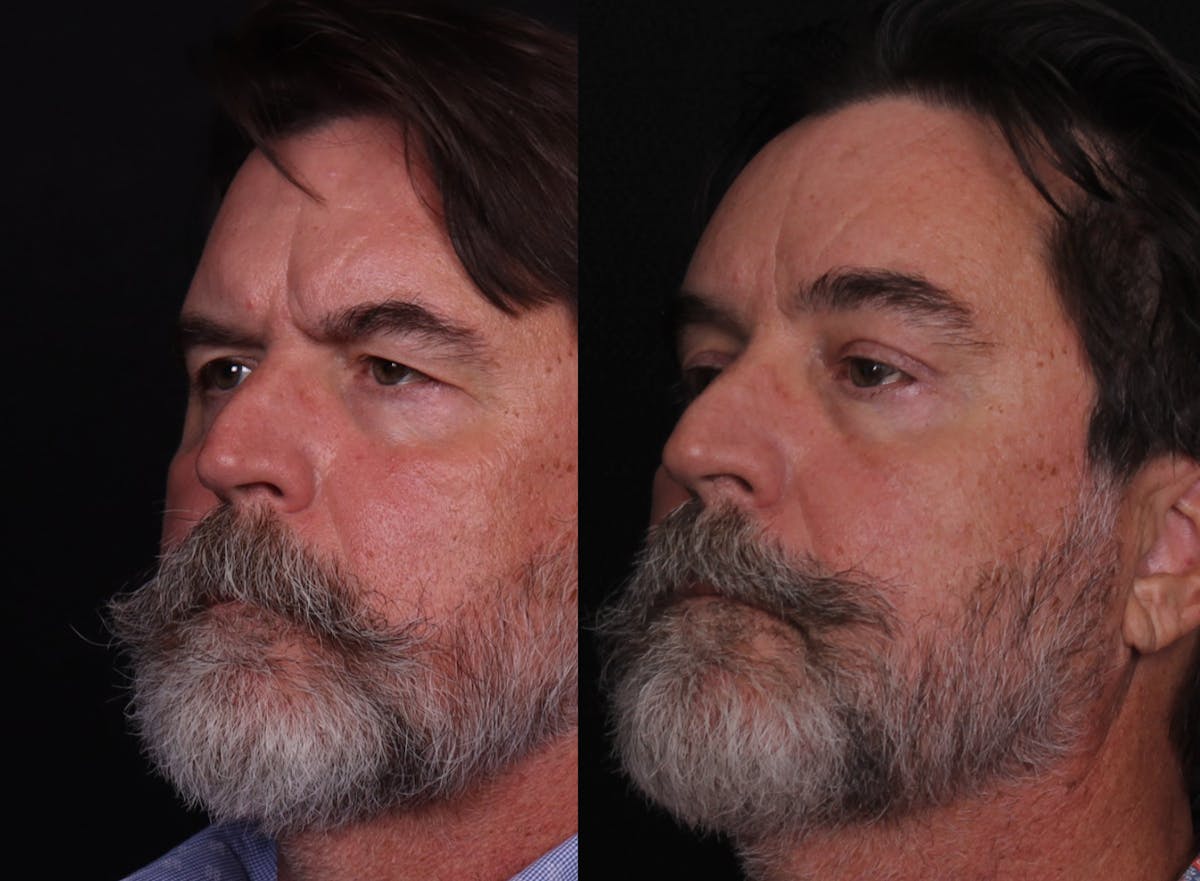 Blepharoplasty & Browlift Before & After Gallery - Patient 198883 - Image 4
