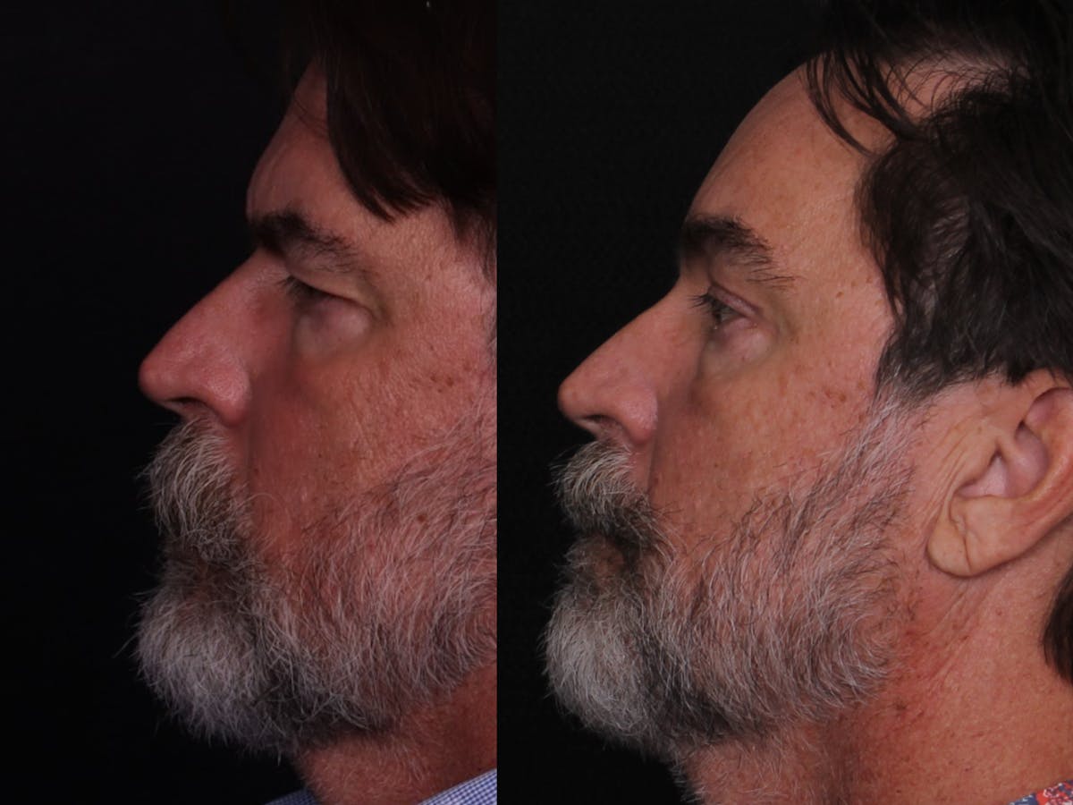 Blepharoplasty & Browlift Before & After Gallery - Patient 198883 - Image 5