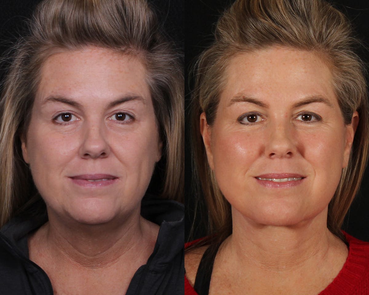 Face & Neck Lift Before & After Gallery - Patient 207988 - Image 3