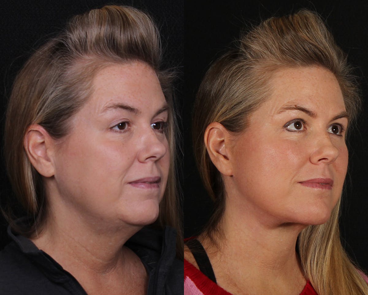 Face & Neck Lift Before & After Gallery - Patient 207988 - Image 1