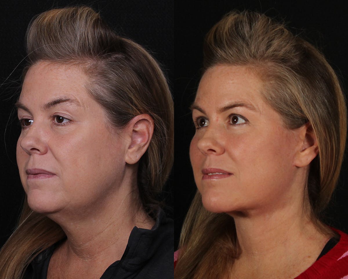 Face & Neck Lift Before & After Gallery - Patient 207988 - Image 5