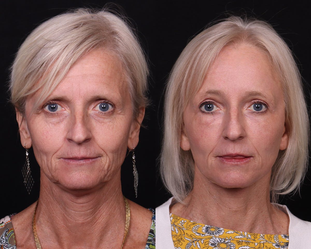 Face & Neck Lift Before & After Gallery - Patient 258923 - Image 1