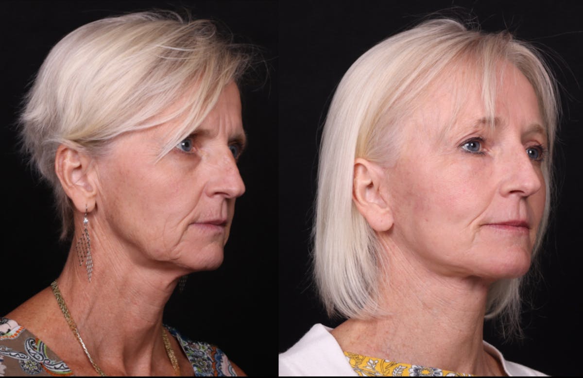 Face & Neck Lift Before & After Gallery - Patient 258923 - Image 2