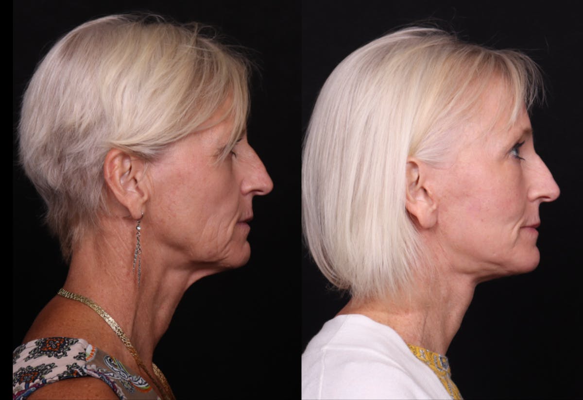 Face & Neck Lift Before & After Gallery - Patient 258923 - Image 3