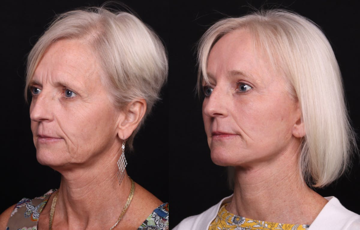 Face & Neck Lift Before & After Gallery - Patient 258923 - Image 4