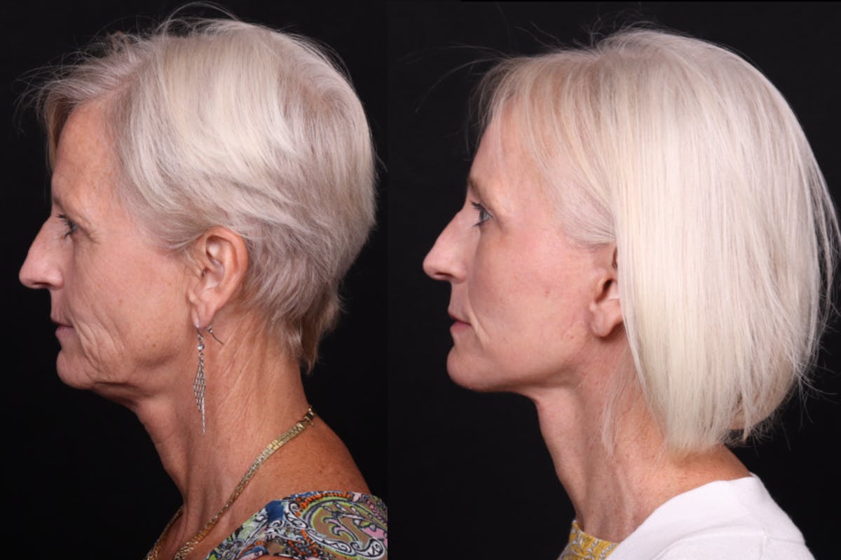 Face & Neck Lift Before & After Gallery - Patient 258923 - Image 5