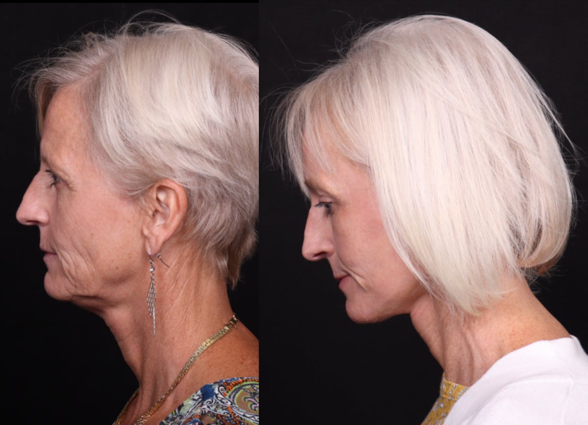 Face & Neck Lift Before & After Gallery - Patient 258923 - Image 6
