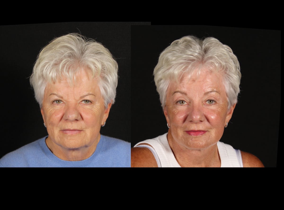 Face & Neck Lift Before & After Gallery - Patient 322422 - Image 1