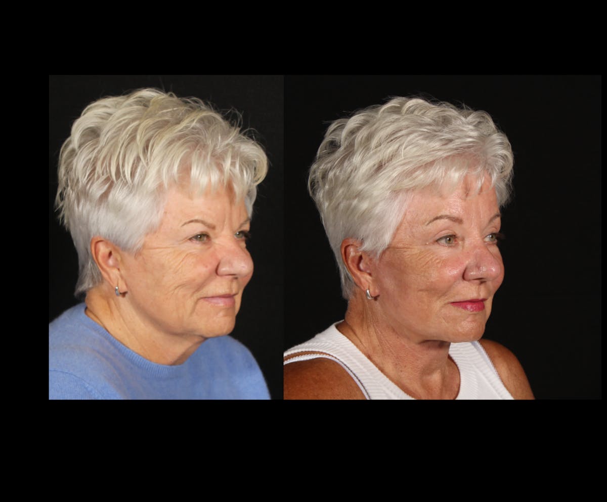 Face & Neck Lift Before & After Gallery - Patient 322422 - Image 2