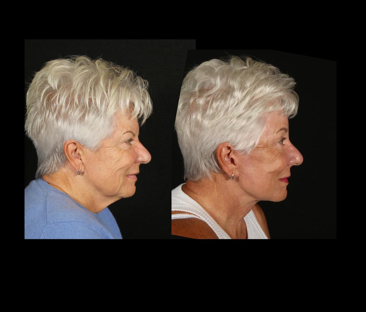 Face & Neck Lift Before & After Gallery - Patient 322422 - Image 3