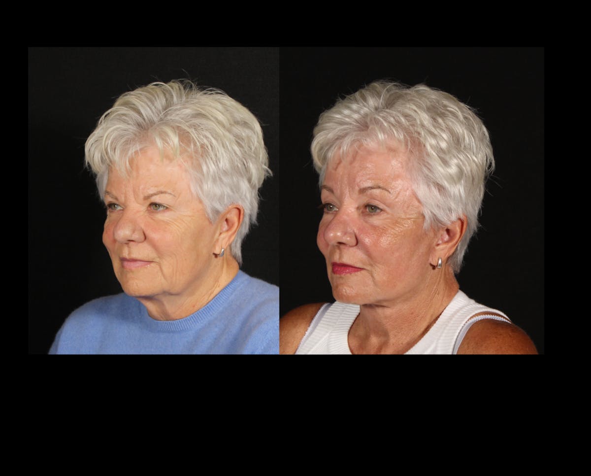 Face & Neck Lift Before & After Gallery - Patient 322422 - Image 4