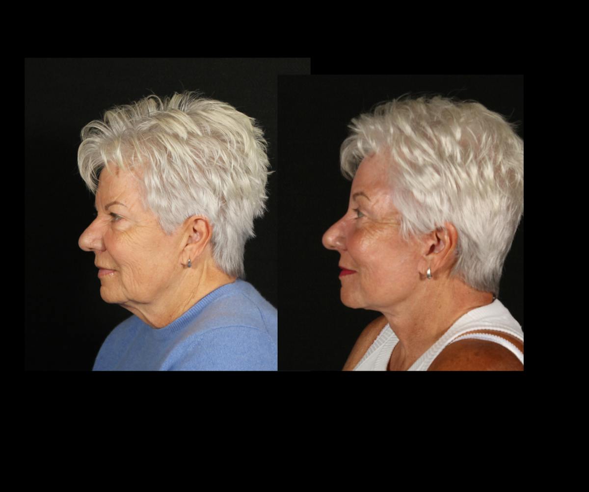 Face & Neck Lift Before & After Gallery - Patient 322422 - Image 5