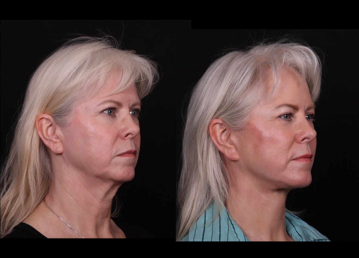 Face & Neck Lift Before & After Gallery - Patient 247742 - Image 2