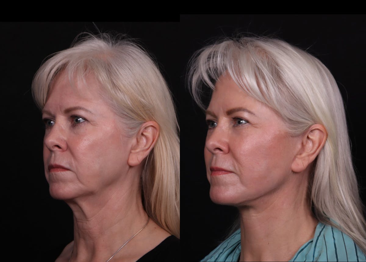 Face & Neck Lift Before & After Gallery - Patient 247742 - Image 4