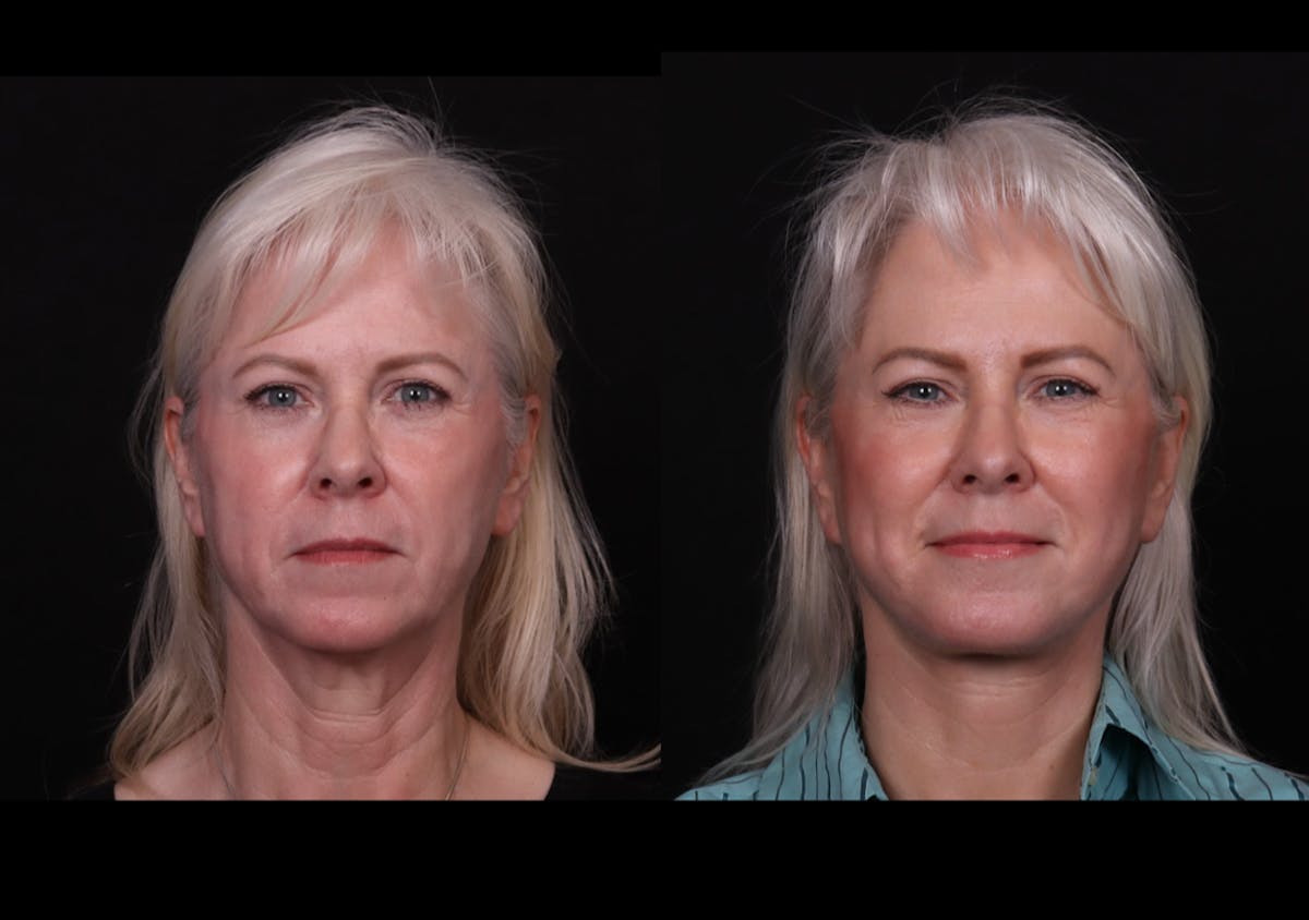 Face & Neck Lift Before & After Gallery - Patient 247742 - Image 1