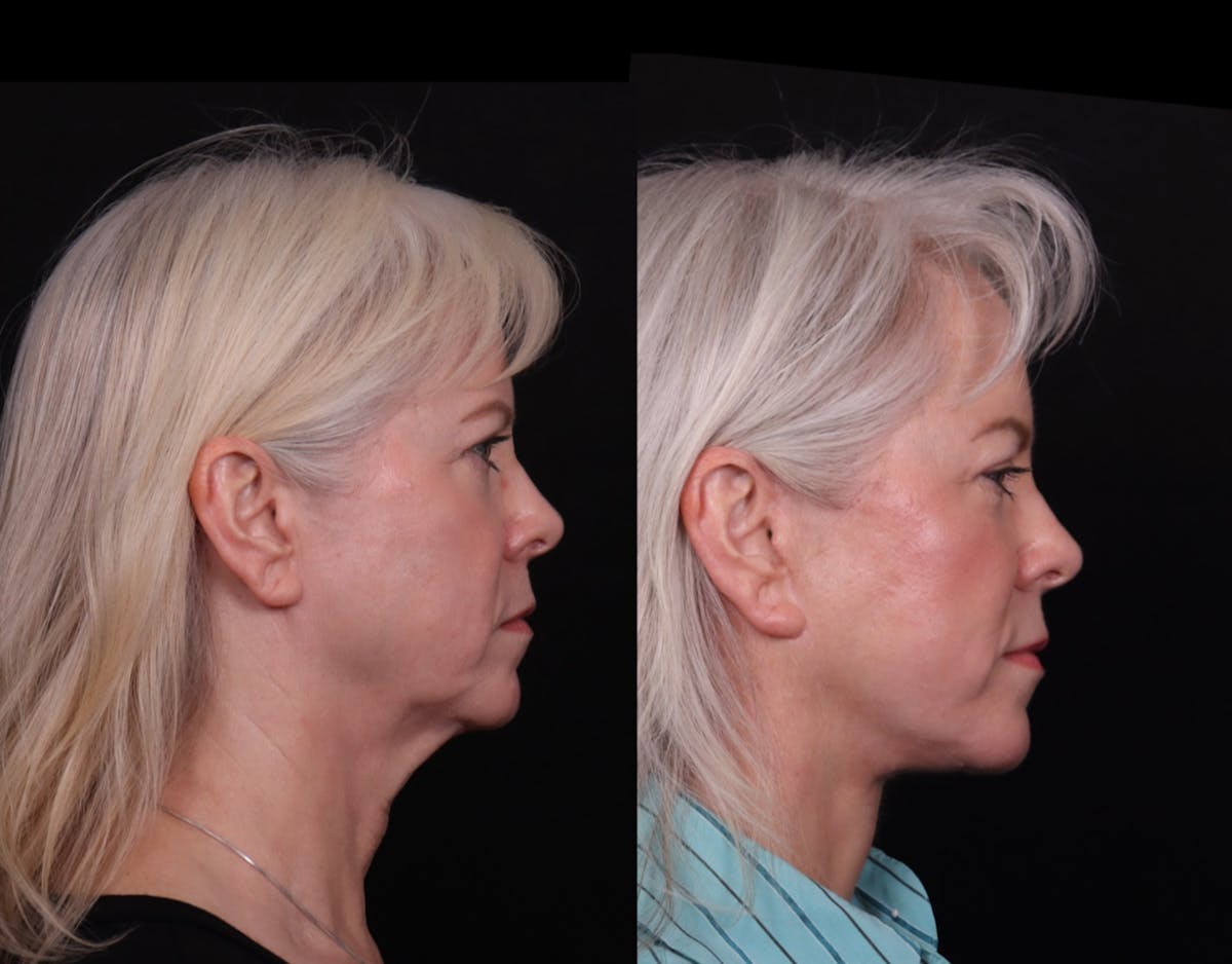 Face & Neck Lift Before & After Gallery - Patient 247742 - Image 3