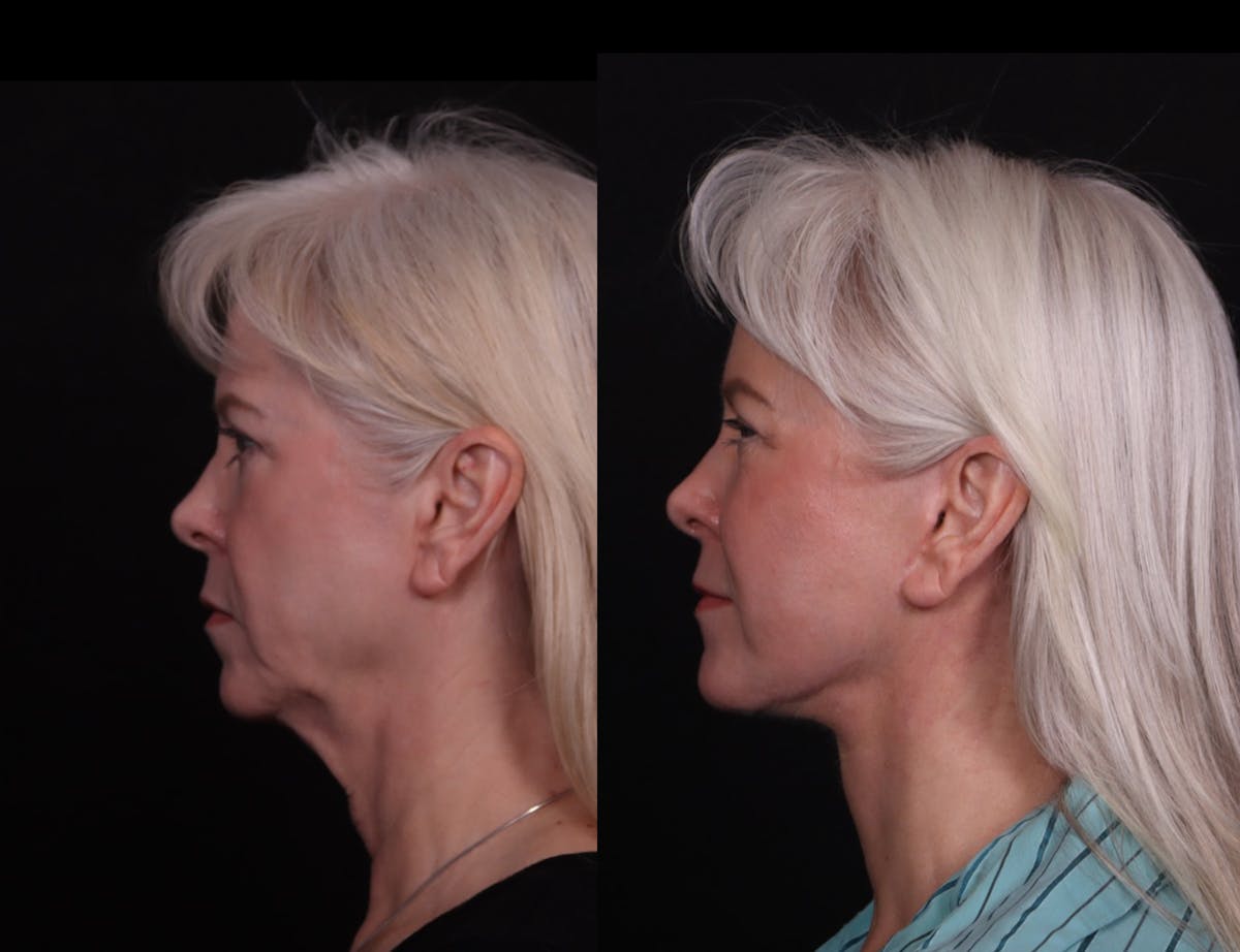 Face & Neck Lift Before & After Gallery - Patient 247742 - Image 5