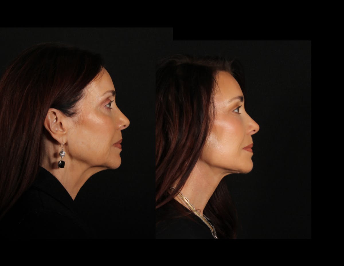 Face & Neck Lift Before & After Gallery - Patient 746300 - Image 3