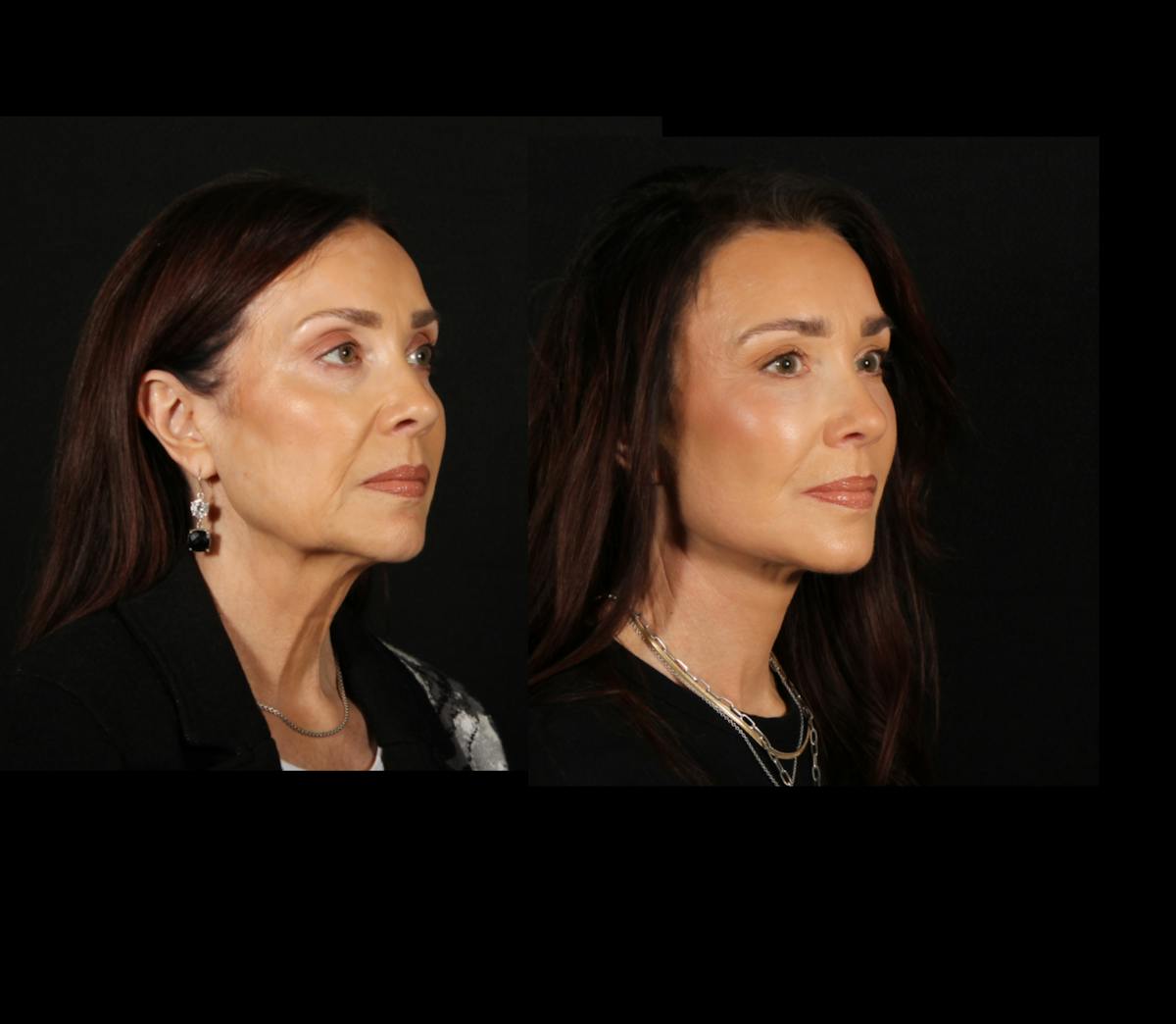 Face & Neck Lift Before & After Gallery - Patient 746300 - Image 2