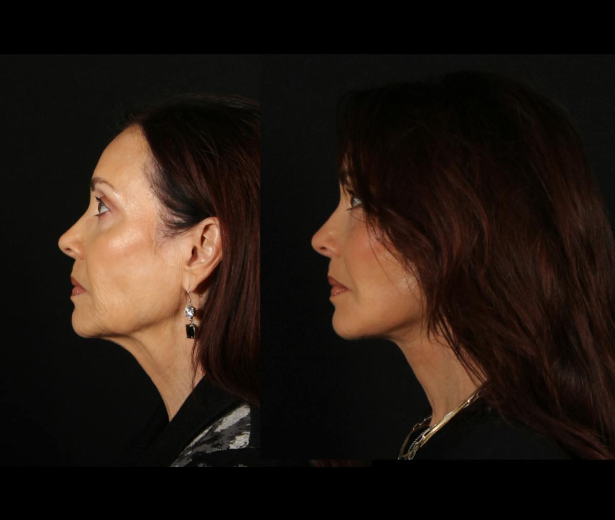 Face & Neck Lift Before & After Gallery - Patient 746300 - Image 4
