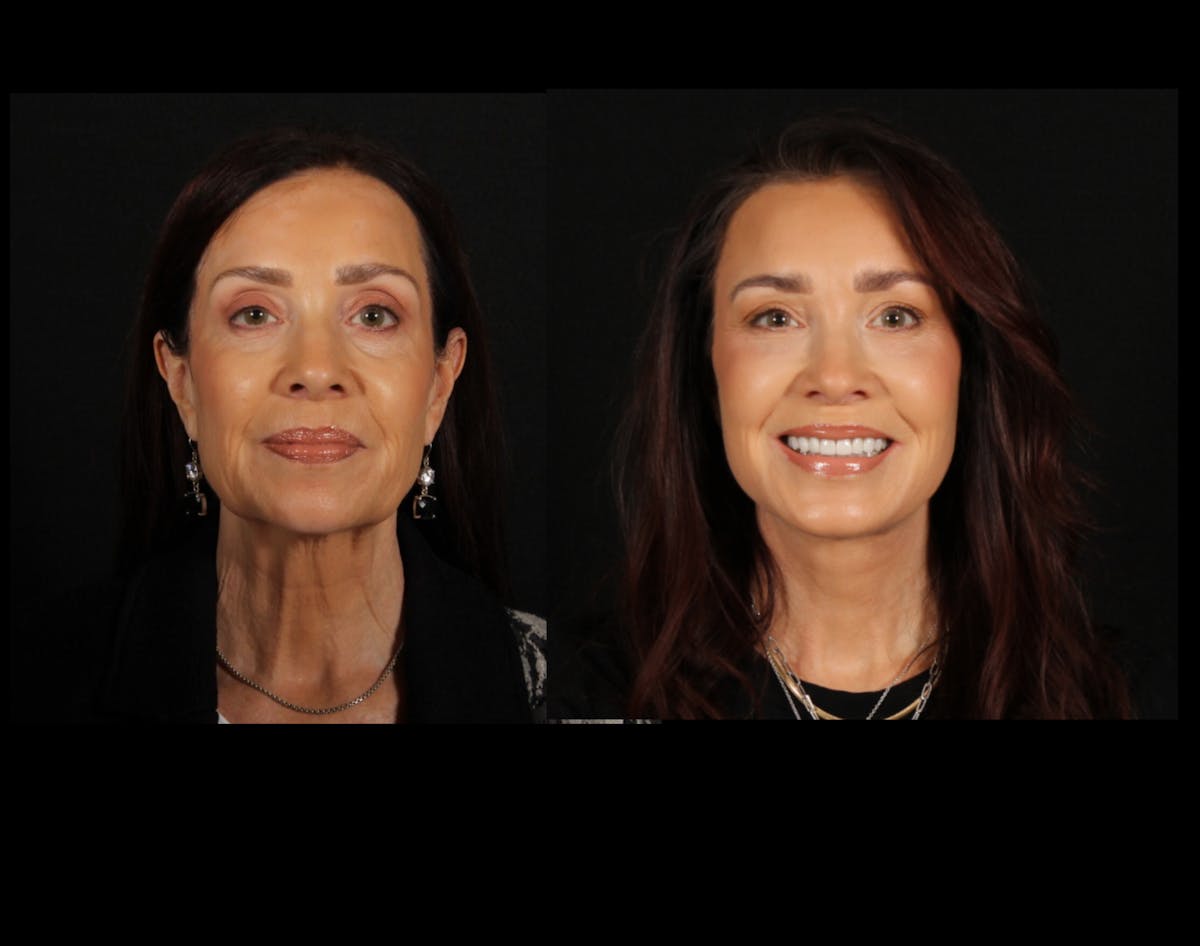 Face & Neck Lift Before & After Gallery - Patient 746300 - Image 1