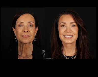 Face & Neck Lift Before & After Gallery - Patient 746300 - Image 1