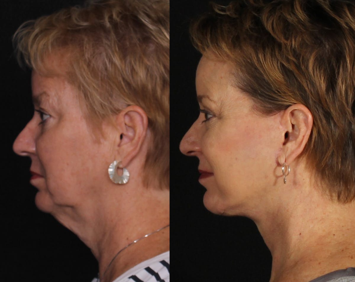 Face & Neck Lift Before & After Gallery - Patient 104467 - Image 5