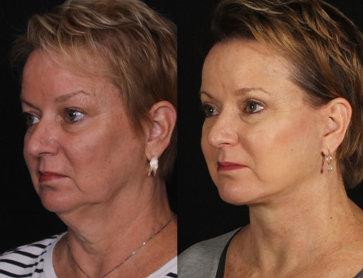 Face & Neck Lift Before & After Gallery - Patient 104467 - Image 4