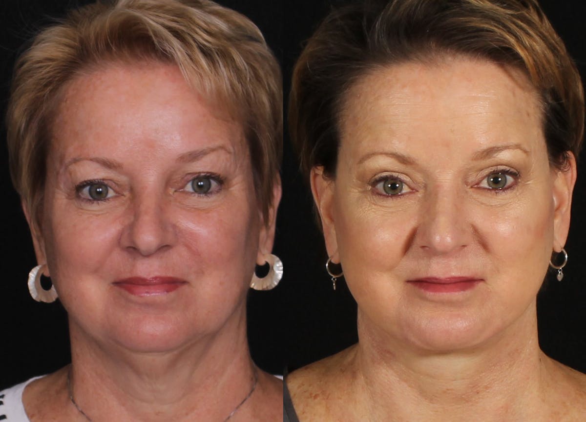 Face & Neck Lift Before & After Gallery - Patient 104467 - Image 1