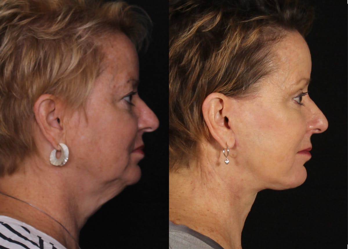 Face & Neck Lift Before & After Gallery - Patient 104467 - Image 3