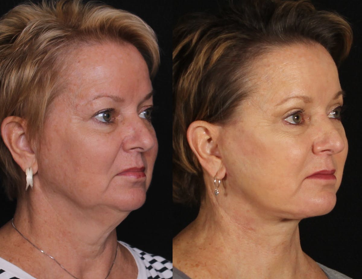 Face & Neck Lift Before & After Gallery - Patient 104467 - Image 2