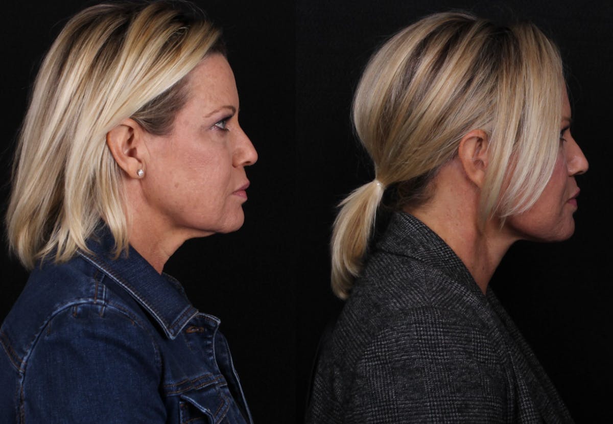 Face & Neck Lift Before & After Gallery - Patient 406808 - Image 3