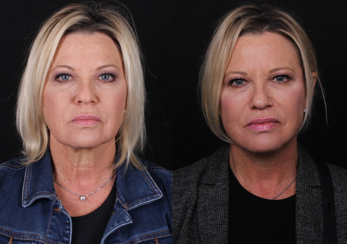 Face & Neck Lift Before & After Gallery - Patient 406808 - Image 1