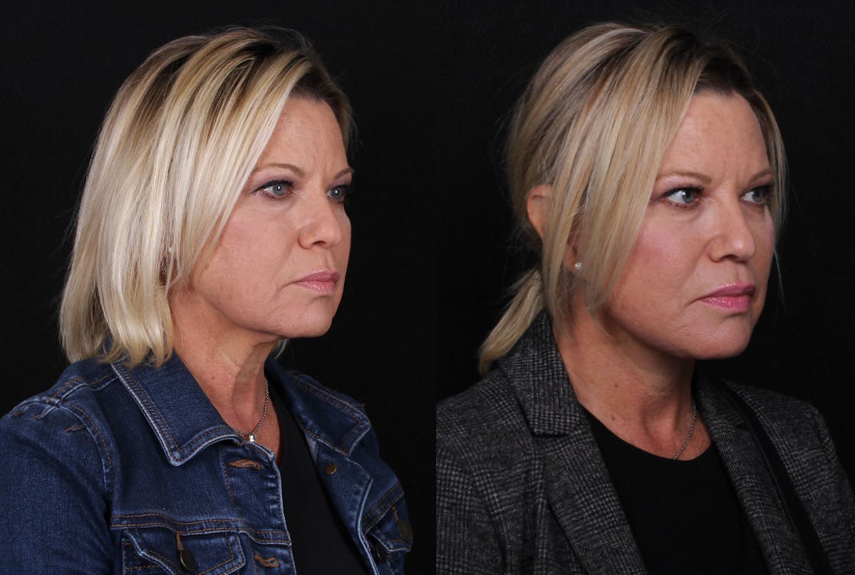 Face & Neck Lift Before & After Gallery - Patient 406808 - Image 2